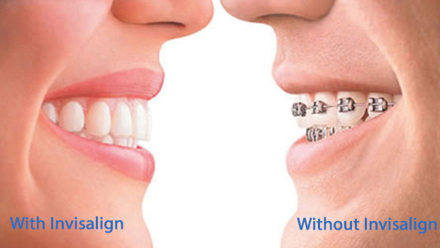 Oxnard Invisalign